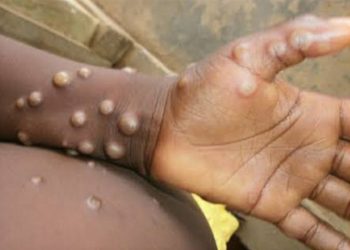 Butembo/santé : la croix rouge vers la course de la prévention du Mpox en milieu carcéral