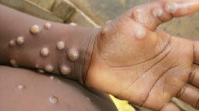 Butembo/santé : la croix rouge vers la course de la prévention du Mpox en milieu carcéral